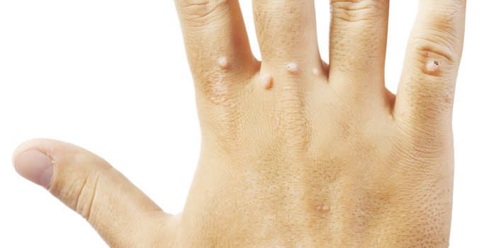 Comment soigner les verrues